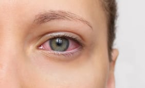What Is Uveitis?